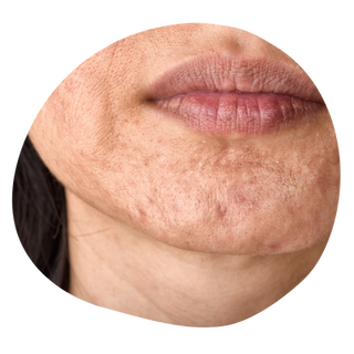 Aknearr