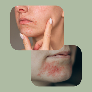 Perioral dermatitt